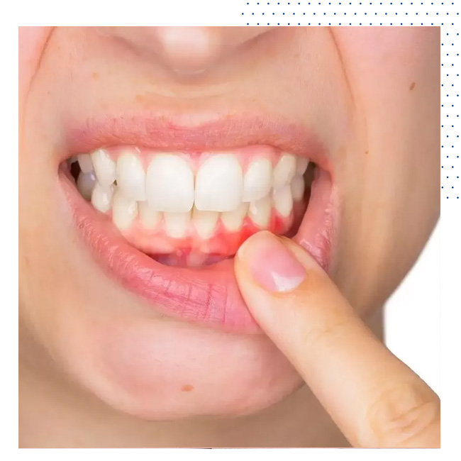 Periodontoloji Diş Eti Hastalıkları