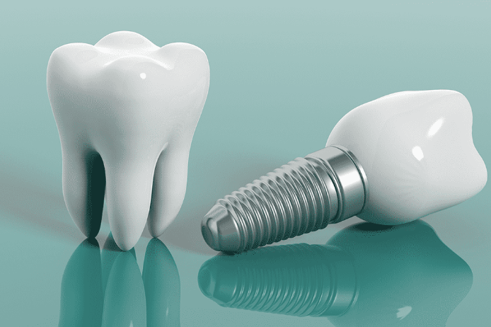 Diş İmplantı Nedir ve Neden Yapılır?