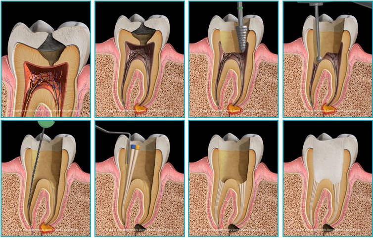 Endodonti ve Kanal Tedavisi