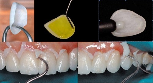 Lamine ( yaprak porselen ) diş nedir ?